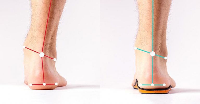 個々の足の状態に合わせて調整された整形外科用インソールが効果を発揮。